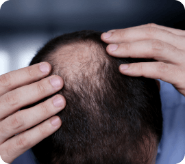 hair thinning